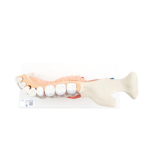 Comprehensive Lower Jaw Model (Left Half) with Diseased Teeth, Nerves, Vessels & Glands, 19 part, 1001250 [VE290], Dental Models