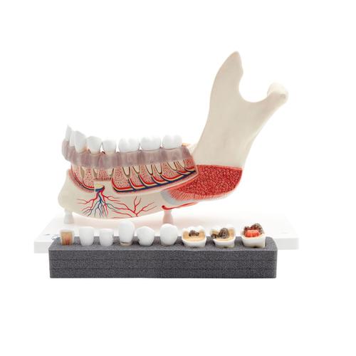 Comprehensive Lower Jaw Model (Left Half) with Diseased Teeth, Nerves, Vessels & Glands, 19 part - 3B Smart Anatomy, 1001250 [VE290], Dental Models