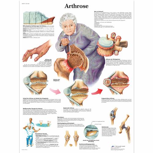 Arthrose, 4006571 [VR0123UU], Educación sobre artritis y osteoporosis