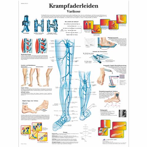 Krampfaderleiden, VarikoseKíváló minőségi 200 gr-os papírra nyomtatva. Praktikus 50x67 cm-es poszter méretben., 4006602 [VR0367UU], Kardiovaszkuláris rendszer