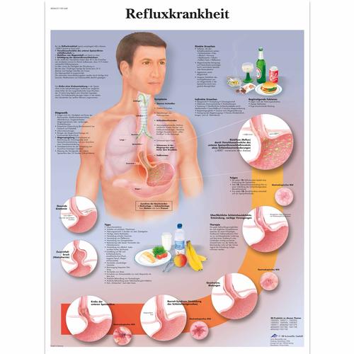 Refluxkrankheit, 1001440 [VR0711L], Sistema digestivo