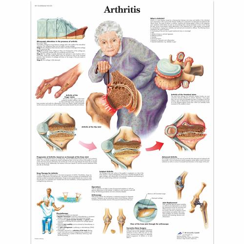 Pôster da Artrite, 1001474 [VR1123L], Informações sobre artrite e osteoporose