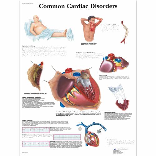 Common Cardiac Disorders, 1001526 [VR1343L], Sistema Cardiovascular