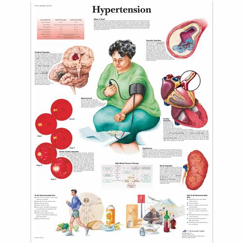 Pôster da Hipertensão, 1001532 [VR1361L], Sistema Cardiovascular