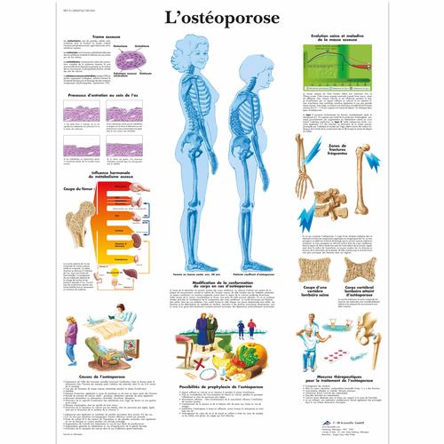 L'ostéoporose, 1001634 [VR2121L], Educación sobre artritis y osteoporosis