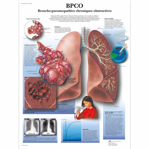 BPCO Broncho-pneumopathies chroniques obstructives, 4006761 [VR2329UU], Tobacco Education