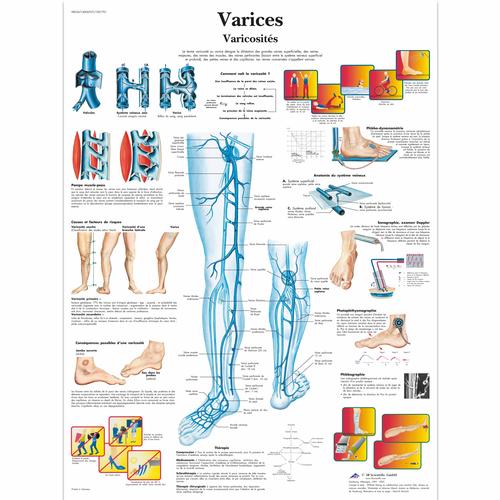 Varices, varicosités, 4006767 [VR2367UU], Cardiovascular System