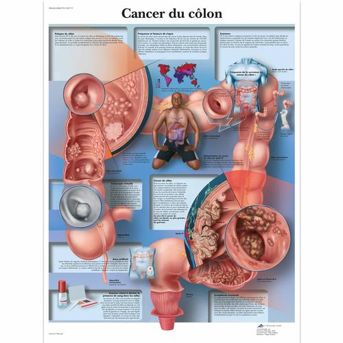 Cancer du côlon, 1001717 [VR2432L], Cânceres