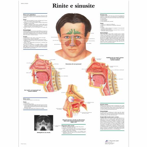 Rinite e sinusite, 4006916 [VR4251UU], 耳，鼻，喉