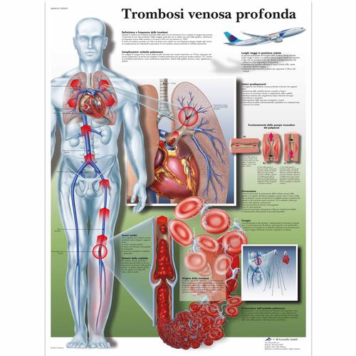 Trombose venosa profonda, 1002037 [VR4368L], système cardiovasculaire