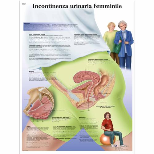 Incontinenza urinaria femminile, 1002071 [VR4542L], 妇科