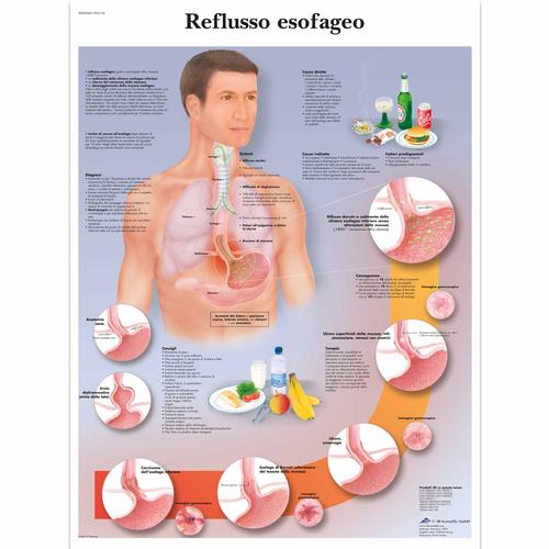 Reflusso esofageo, 1002106 [VR4711L], Emésztőrendszer