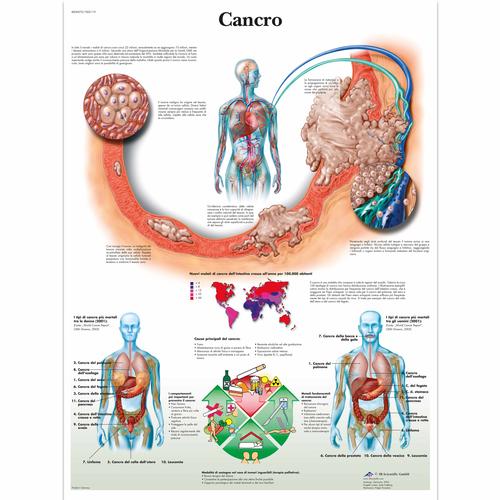 Cancro, 4006975 [VR4753UU], Los tipos de cáncer