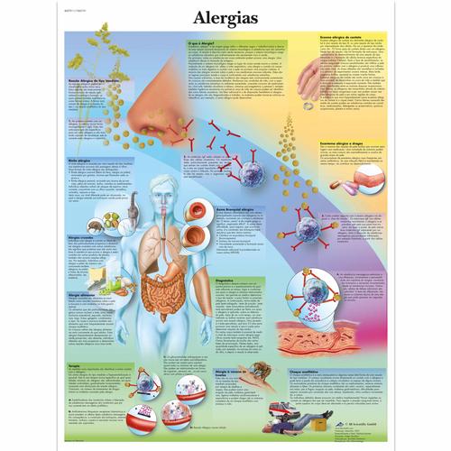 Alergias, 1002191 [VR5660L], Sistema inmunitario