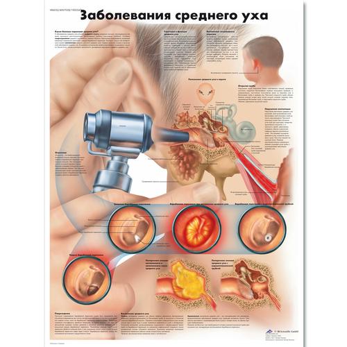 Медицинский плакат "Заболевания среднего уха", 1002247 [VR6252L], Oreja, Nariz, Garganta