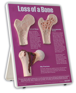 Loss of Bone Easel Display, 3004674 [W43124], Educación sobre artritis y osteoporosis