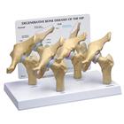 Модель, демонстрирующая 4 стадии дегенеративных заболеваний костей тазобедренного сустава, 1019506, Модели гениталий и таза