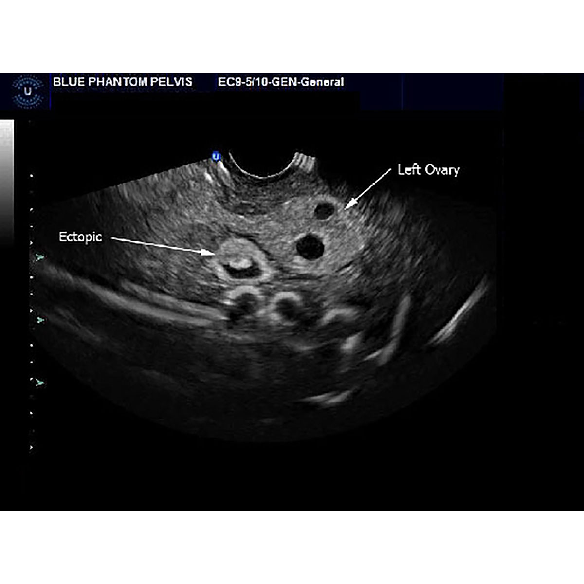 Blue Phantom Ectopic Pregnancy Transvaginal Ultrasound My Xxx Hot Girl