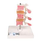 Deluxe Human Osteoporosis Model (3 Vertebrae with Discs ), Removable on Stand, 1000153 [A78], Arthritis and Osteoporosis Education