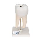 Lower Twin-Root Molar with Cavities Human Tooth Model, 2 part, 1000243 [D10/4], Dental Models