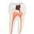 Lower Twin-Root Molar with Cavities Human Tooth Model, 2 part, 1000243 [D10/4], Dental Models (Small)