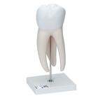 Giant Molar with Dental Cavities Human Tooth Model, 15 times Life-Size, 6 part, 1013215 [D15], Dental Models