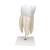 Giant Molar with Dental Cavities Human Tooth Model, 15 times Life-Size, 6 part, 1013215 [D15], Dental Models (Small)