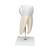 Giant Molar with Dental Cavities Human Tooth Model, 15 times Life-Size, 6 part, 1013215 [D15], Dental Models (Small)