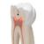 Giant Molar with Dental Cavities Human Tooth Model, 15 times Life-Size, 6 part, 1013215 [D15], Dental Models (Small)