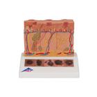 Skin Cancer Model with 5 stages, 8 times magnified, 1000293 [J15], Skin Models