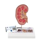 Kidney Stone Model, 1000316 [K29], Urology Models