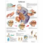 Arthrose, 1001308 [VR0123L], 关节炎和骨质疏松症示意图
