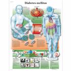 Diabetes mellitus, 1001391 [VR0441L], Плакаты по метаболической системе