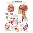 Der Schlaganfall, 4006630 [VR0627UU], Плакаты по кардиоваскулярной системе