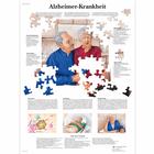 Alzheimer-Krankheit, 1001428 [VR0628L], Плакаты по мозгу и нервной системе