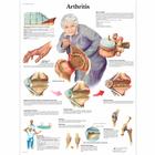 Arthritis Chart, 1001474 [VR1123L], Strumenti didattici su artrite e osteoporosi