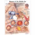Diseases of the Middle Ear, 1001506 [VR1252L], Плакаты по Уху, Горлу, Носу (ЛОР)
