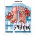 Pneumonia, 1001518 [VR1326L], Плакаты по паразитам, вирусам, бактериям
