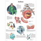Asthma, 1001520 [VR1328L], Плакаты по дыхательной системе человека