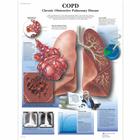 COPD Chronic Obstructive Pulmonary Disease, 1001522 [VR1329L], Плакаты по дыхательной системе человека