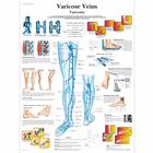 Varicose Veins, 4006684 [VR1367UU], Плакаты по кардиоваскулярной системе