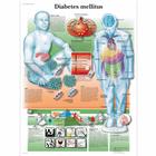 Diabetes mellitus, 1001554 [VR1441L], Плакаты по метаболической системе