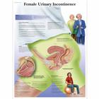Female Urinary Incontinence, 1001570 [VR1542L], Плакаты по гинекологии