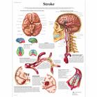 Stroke, 1001590 [VR1627L], Плакаты по кардиоваскулярной системе