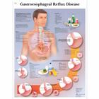 Gastroesophageal reflux disease, 4006718 [VR1711UU], Плакаты по пищеварительной системе