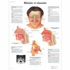 Lehrtafel - Rhinite et sinusite, 4006752 [VR2251UU], Hals, Nasen und Ohren (HNO)