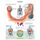 Cancer, 4006805 [VR2753UU], Los tipos de cáncer