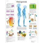 Osteoporosis, 4006816 [VR3121UU], 关节炎和骨质疏松症示意图