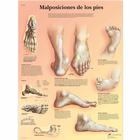  Malposiciones de los pies, 1001823 [VR3185L], 骨骼系统
