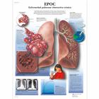 EPOC Enfermedad pulmonar obstructiva crónica, 4006840 [VR3329UU], Informações sobre o tabaco